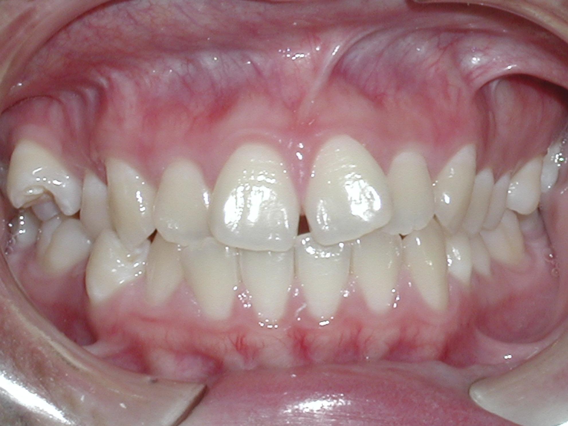 Extraction 2 case picture 1