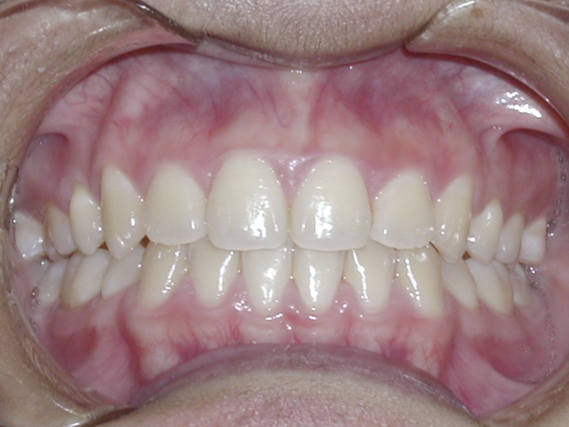 Extraction 2 case picture 2
