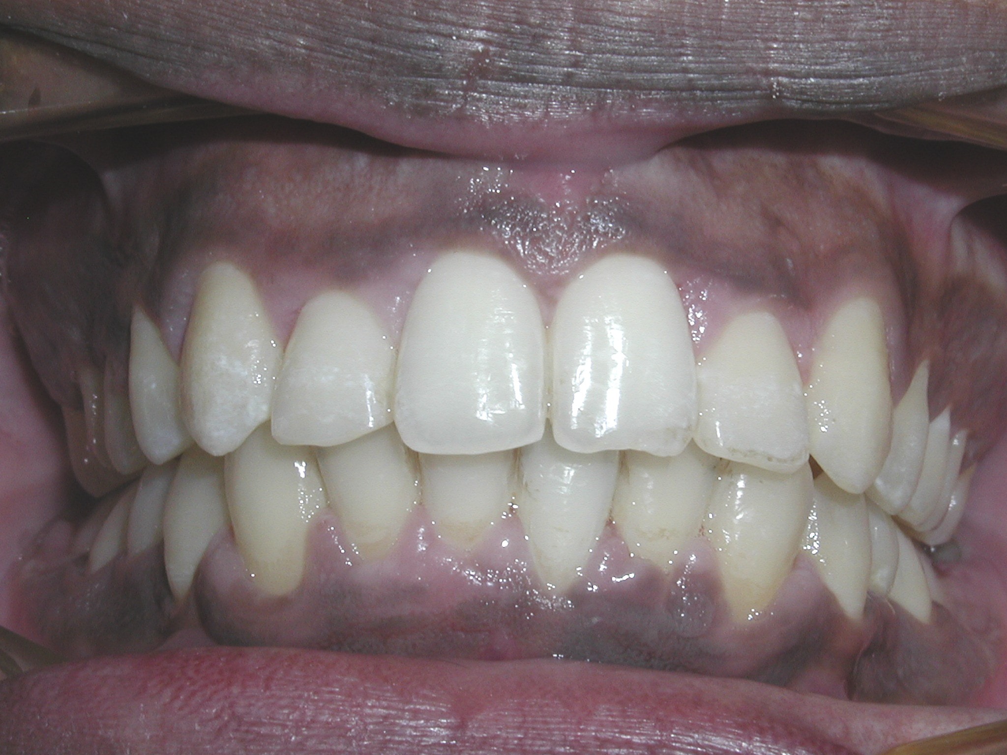 Extraction case picture 3