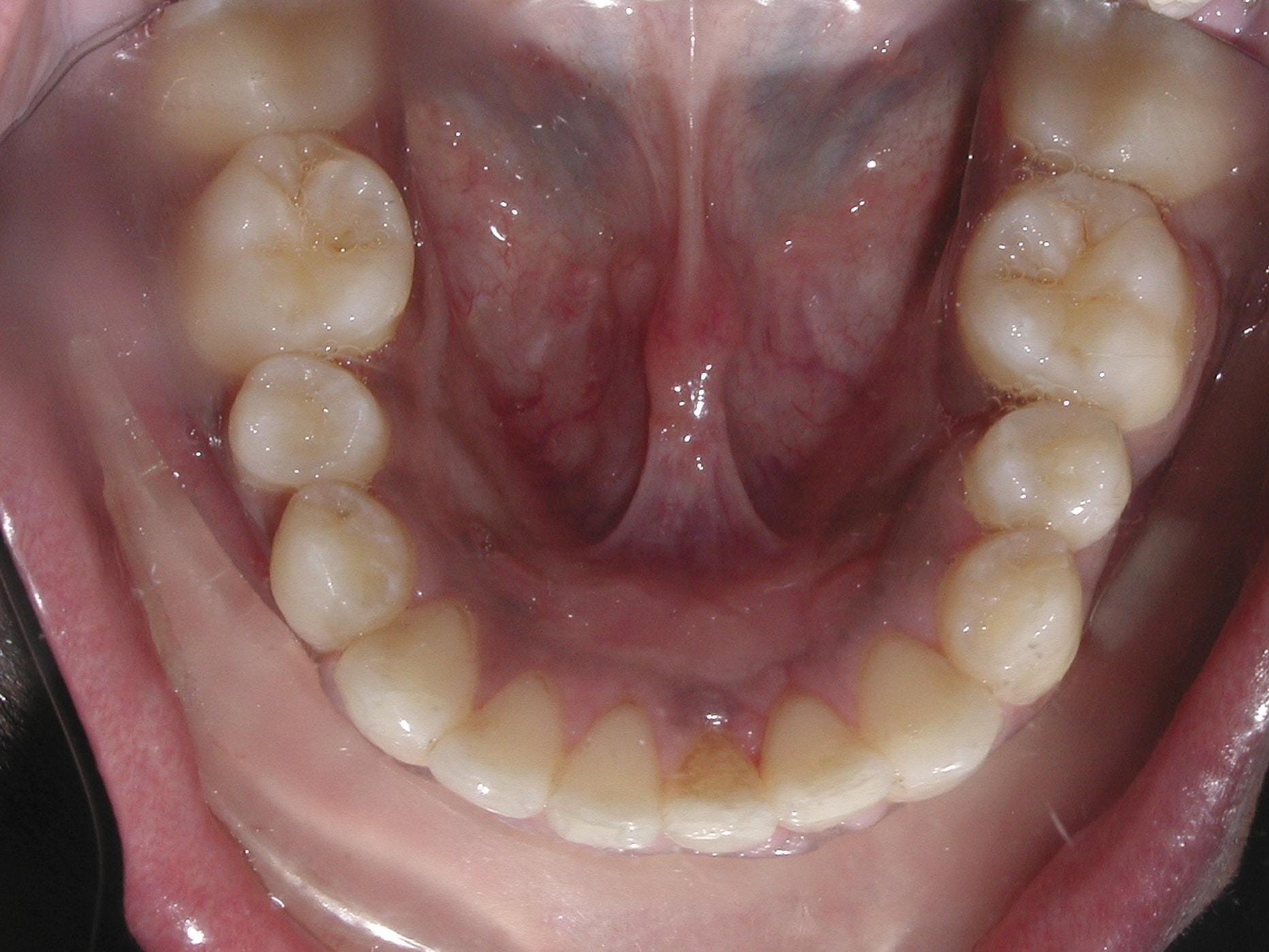 Extraction case picture 4