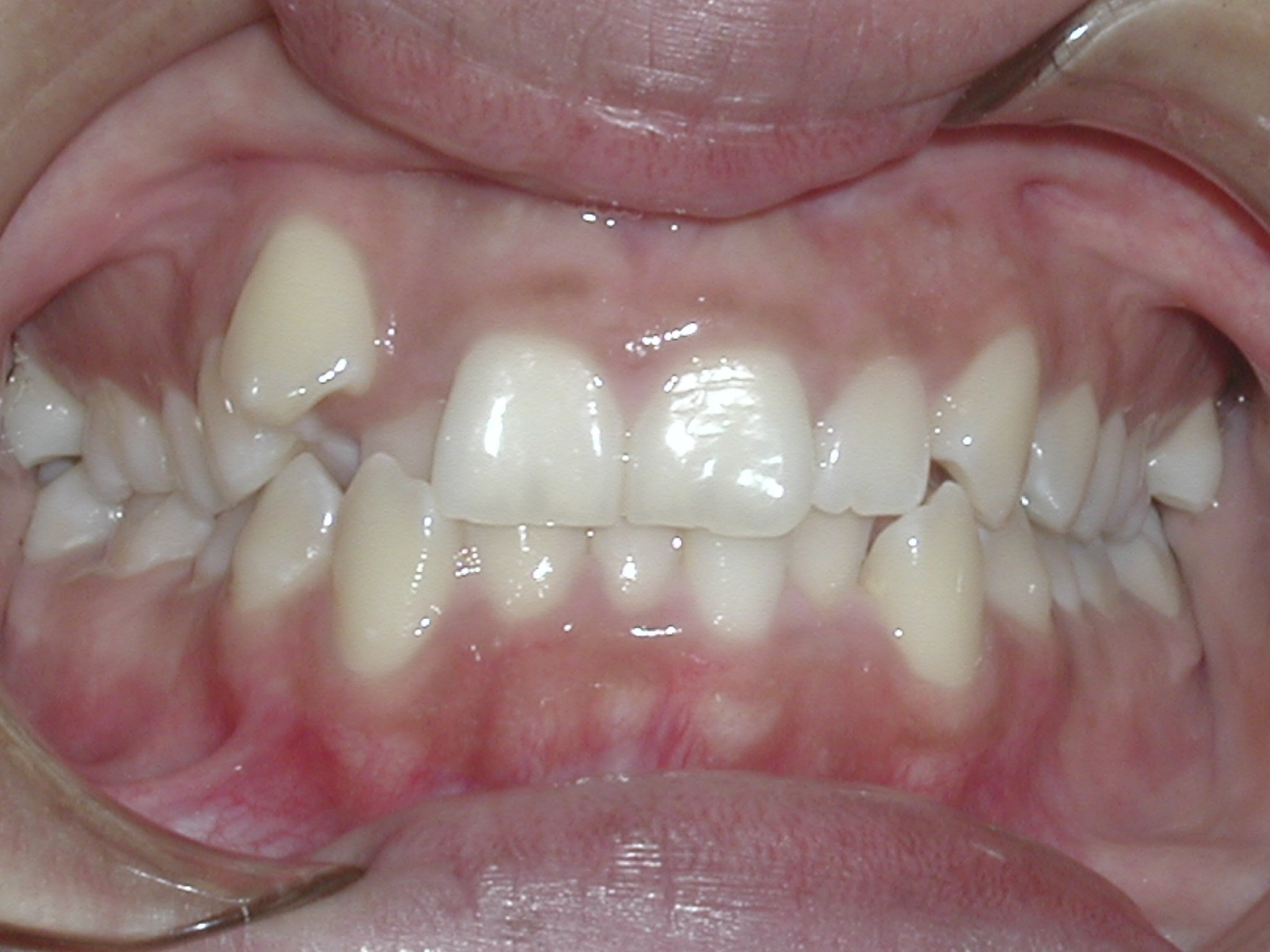 Non-extraction case picture 1