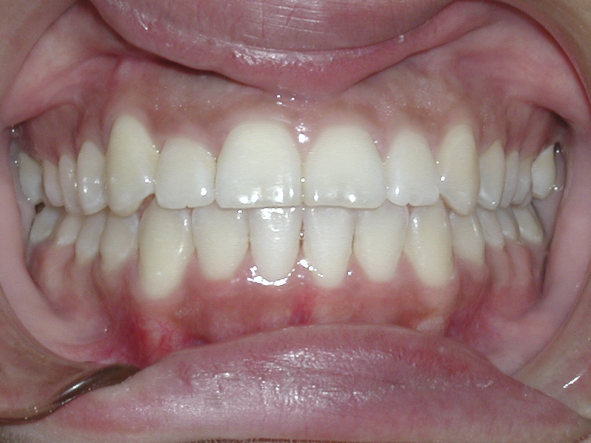 Non-extraction case picture 2